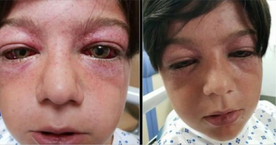 Playground craze leaves 11-year-old boy “looking like an alien” – mom issues warning for parents